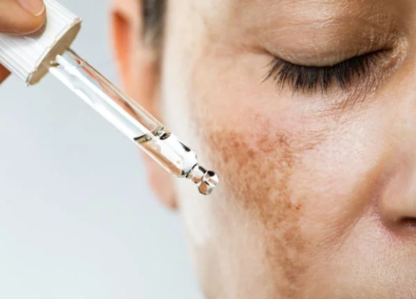 Fotosensibilidad con piel facial manchada