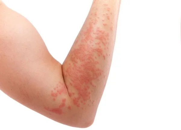Sensibilización al uso de aceites esenciales con brazo lleno de lesiones rojas e inflamadas