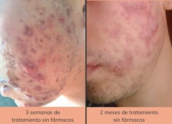 tratamiento-natural-para-el-acne-a-distancia