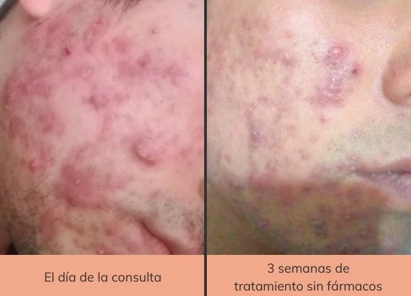 tratamiento-natural-para-el-acne